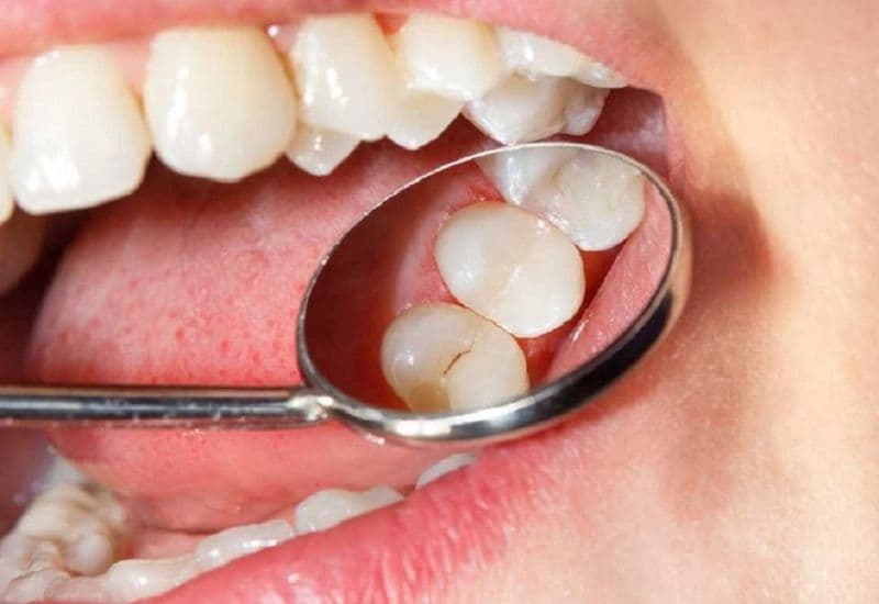 Do biểu hiện mờ nhạt, sâu răng hàm nhẹ dễ bị bỏ qua.