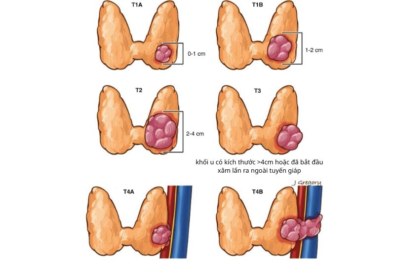 hiểu về kích thước khối u tuyến giáp