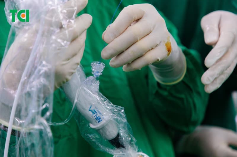 Vì sao cần lựa chọn đúng cơ sở để tán sỏi thận nội soi?