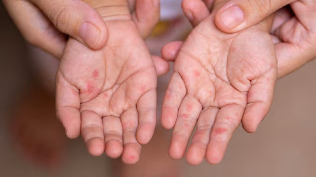 Thời gian ủ bệnh tay chân miệng ở trẻ