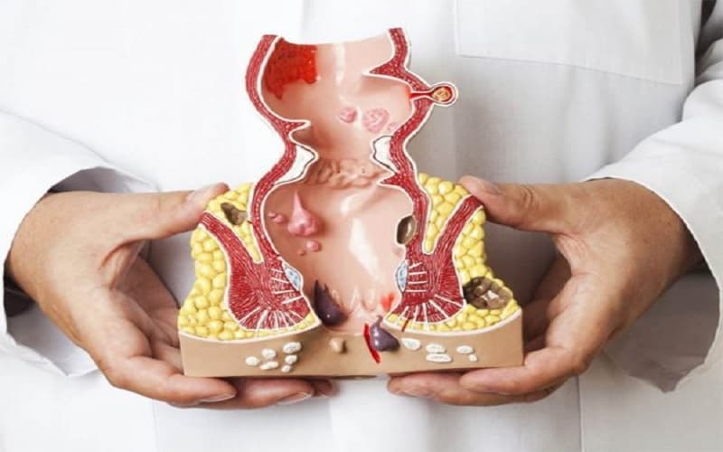 Trĩ được hình thành do sự giãn nở quá mức của các đám rối tĩnh mạch quanh hậu môn, dẫn đến viêm sưng, phồng và gây đau rát.