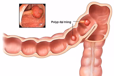 Triệu chứng của polyp đại tràng: Những dấu hiệu không nên bỏ qua