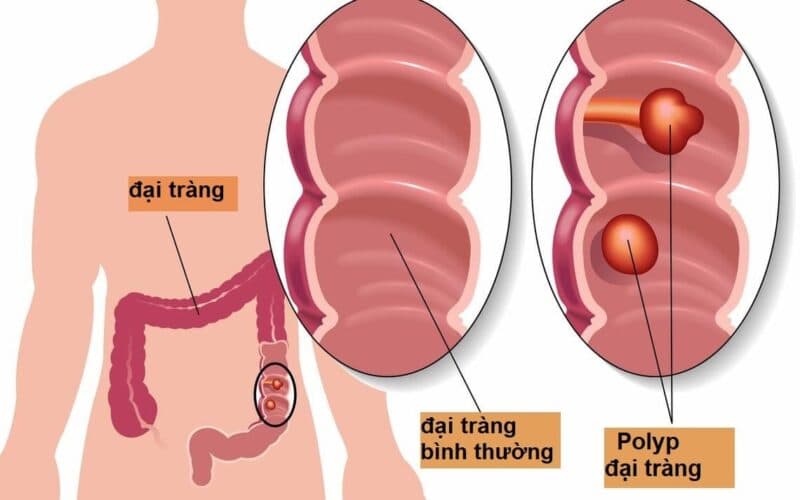 Triệu chứng của polyp đại tràng thường mờ nhạt