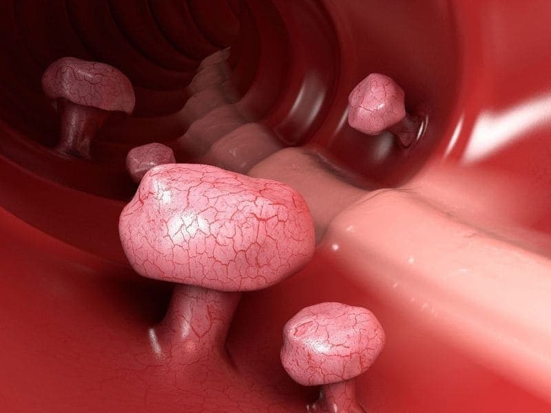 Một người có thể có 1 hoặc nhiều polyp đại tràng