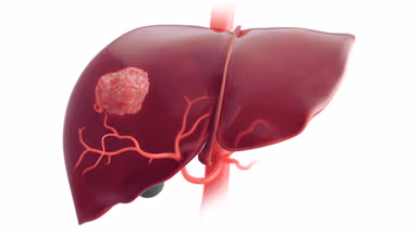10 Câu hỏi thường gặp khi tư vấn ung thư gan – Giải đáp chi tiết