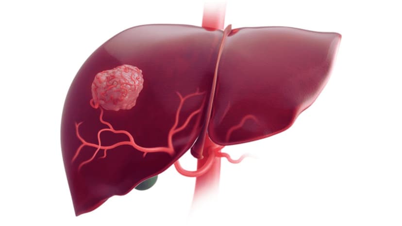 10 Câu hỏi thường gặp khi tư vấn ung thư gan – Giải đáp chi tiết