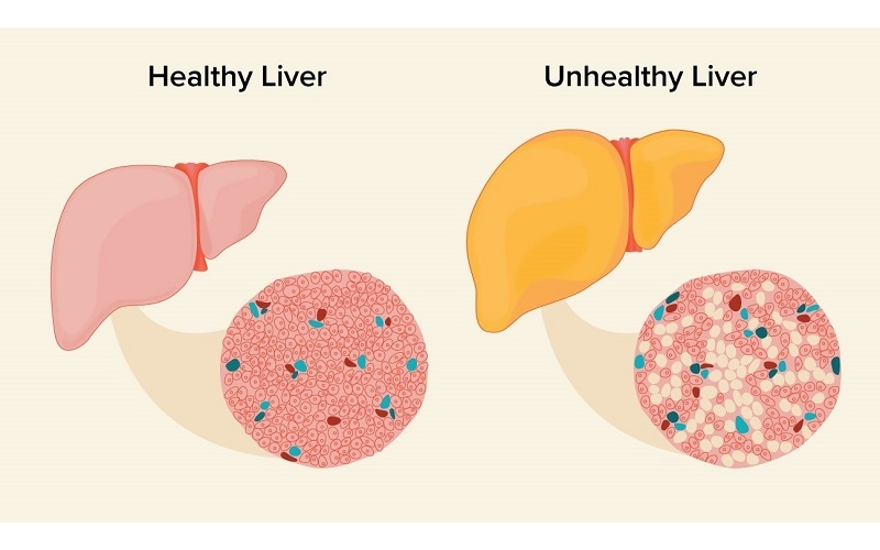 Khi chức năng gan suy yếu, các chất độc như amoniac không được đào thải ra khỏi cơ thể mà ngấm vào máu và đi lên não
