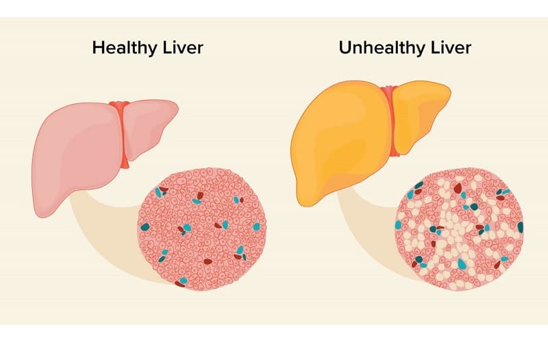 Khi chức năng gan suy yếu, các chất độc như amoniac không được đào thải ra khỏi cơ thể mà ngấm vào máu và đi lên não