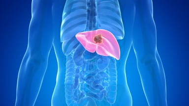 Ung thư gan là cái gì mà cần tìm hiểu rõ về bệnh này