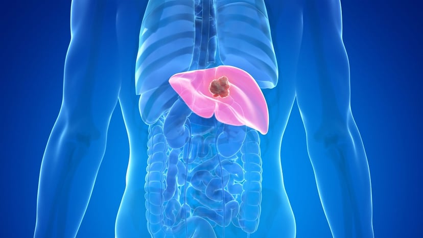 Ung thư gan là cái gì mà cần tìm hiểu rõ về bệnh này