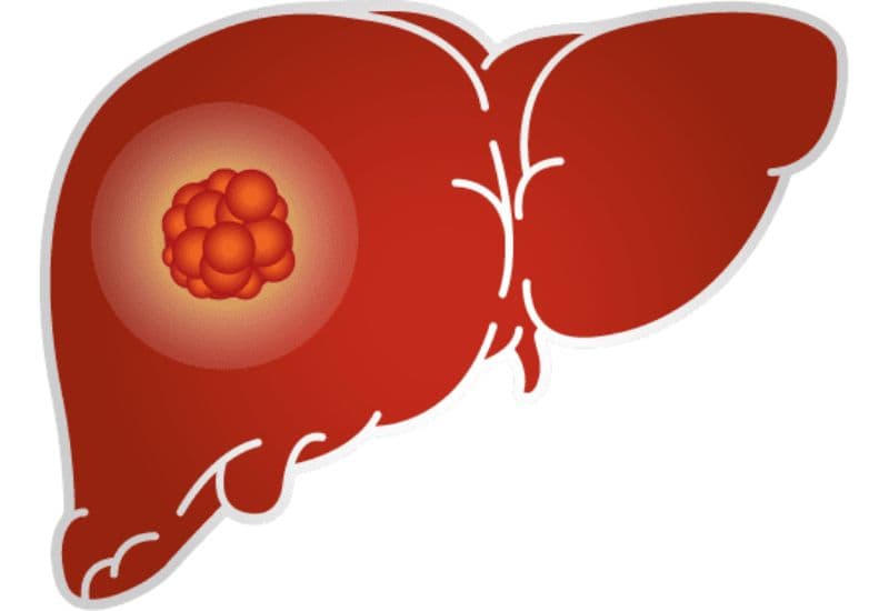 Mối liên hệ nguy hiểm giữa viêm gan B và ung thư gan
