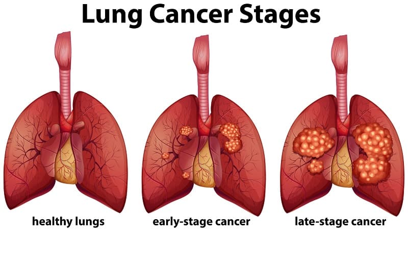 nếu được phát hiện sớm và điều trị đúng cách, nhiều người bệnh ung thư phổi vẫn có thể sống lâu dài