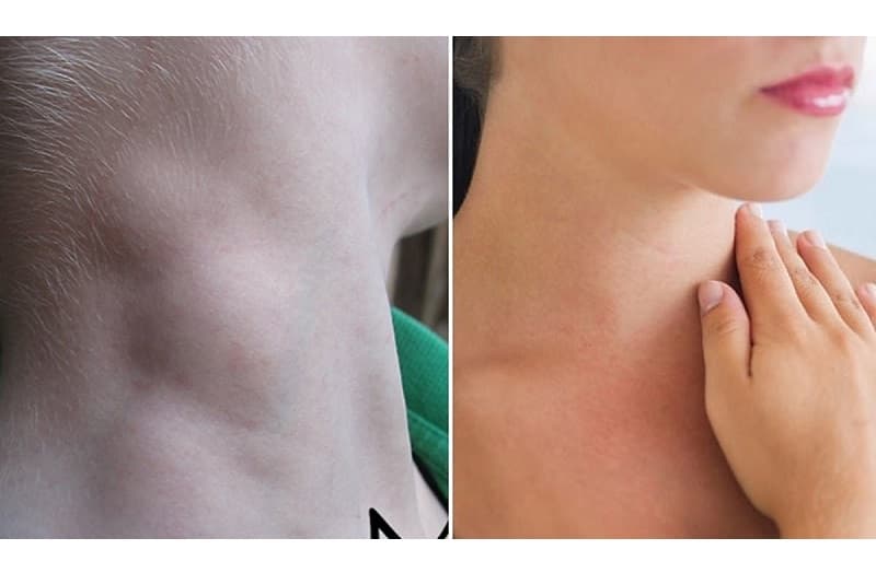 Nổi hạch vùng cổ sau góc hàm là một trong những dấu hiệu điển hình của ung thư vòm họng