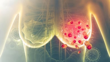 Ung thư vú có chữa được không nếu phát hiện kịp thời