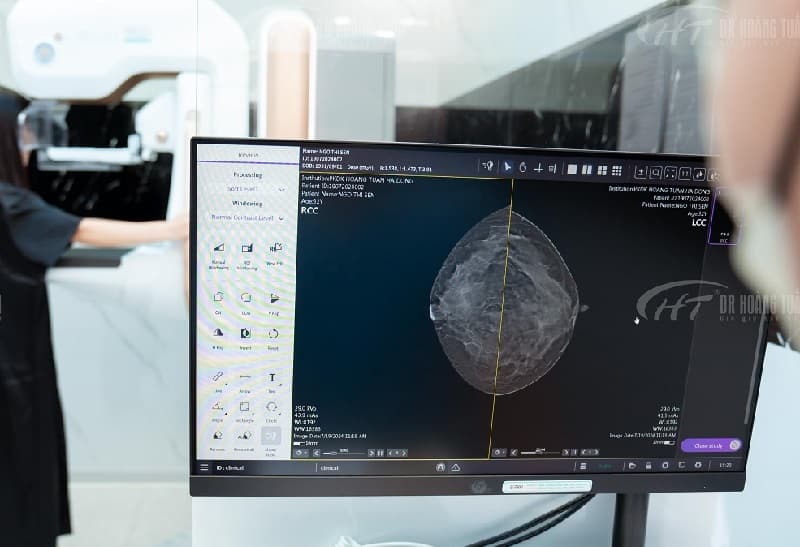 Ung thư vú có thể chữa khỏi, đặc biệt nếu được phát hiện ở giai đoạn sớm. Hiện nay, nhờ vào những tiến bộ vượt bậc trong y học