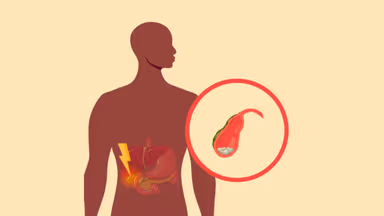 Viêm túi mật do sỏi: Cơ chế hình thành và cách ngăn ngừa