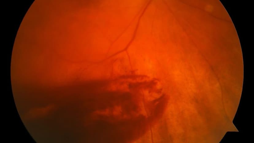 Xuất huyết dịch kính sau chấn thương – Nguyên nhân và điều trị