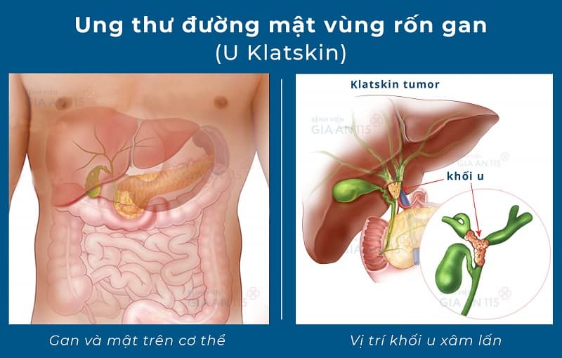 Ung thư đường mật rốn gan là một thể ung thư xuất phát từ các tế bào nằm trong hệ thống ống mật - mạng lưới ống dẫn mật từ gan xuống ruột non nhằm hỗ trợ quá trình tiêu hóa