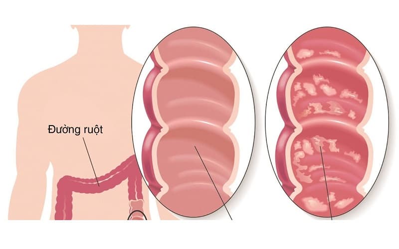 u đường mật Klatskin