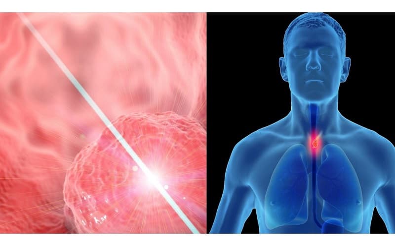 Ung thư đường mật rốn gan thường được phân thành các giai đoạn từ 0 đến IVB