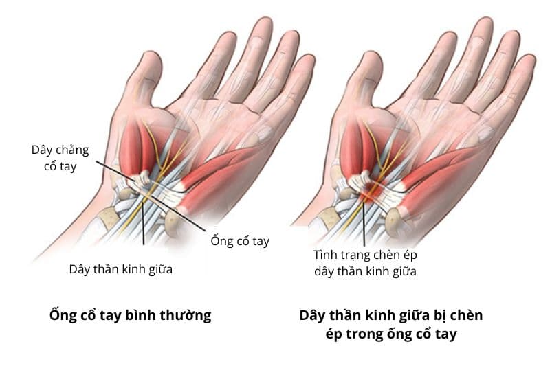 hội chứng ống cổ tay