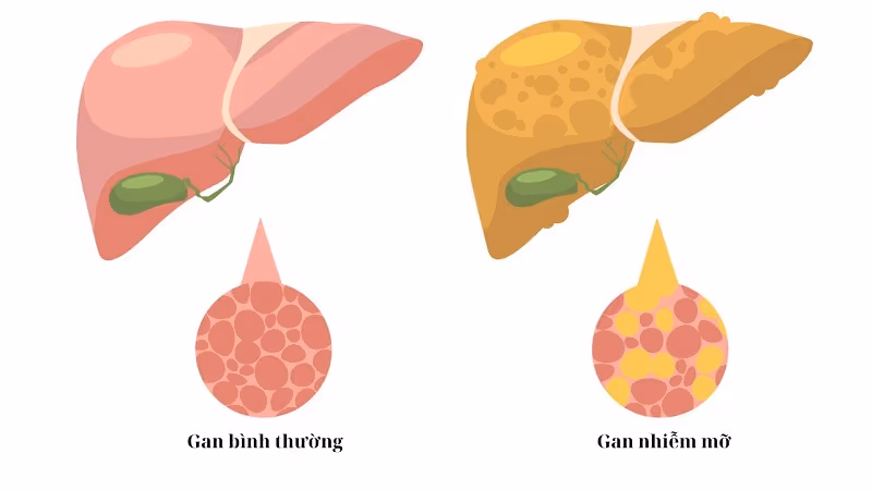 Gan nhiễm mỡ là bệnh gì, biểu hiện ra sao?