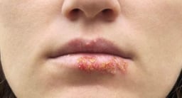 Nỗi ám ảnh mang tên bệnh mụn rộp herpes ở môi và cách điều trị