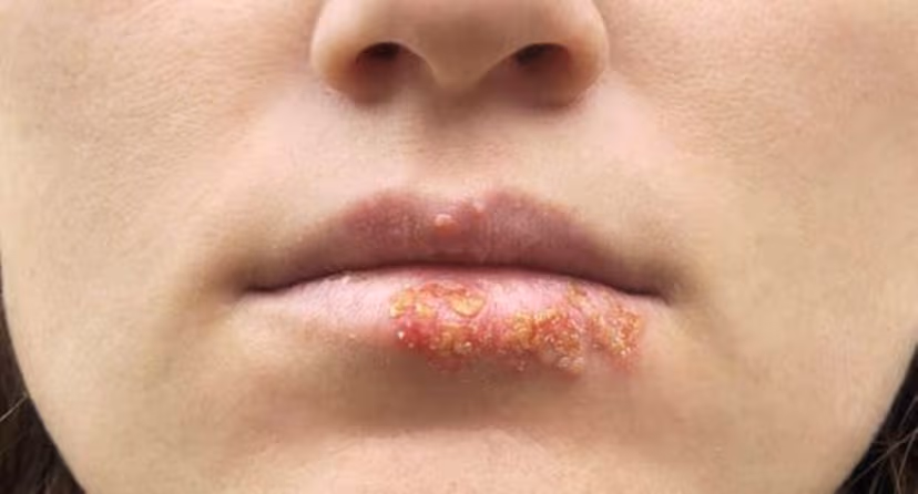 Nỗi ám ảnh mang tên bệnh mụn rộp herpes ở môi và cách điều trị