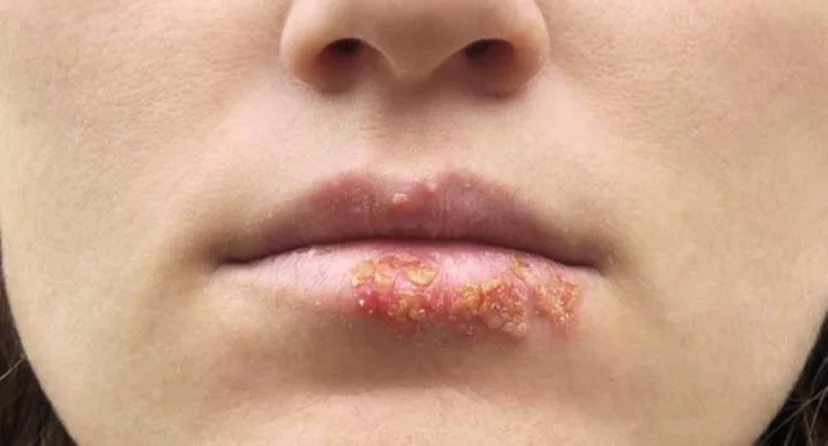 Nỗi ám ảnh mang tên bệnh mụn rộp herpes ở môi và cách điều trị