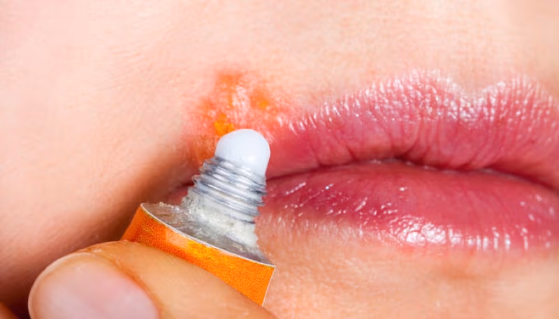 Bệnh mụn rộp herpes ở môi cần điều trị bằng thuốc kháng virus