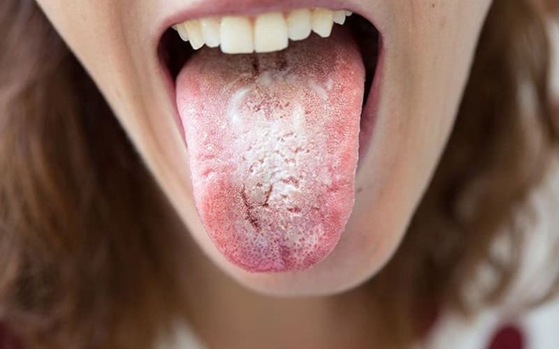 Bệnh nấm quanh miệng có thể xảy ra ở cả người lớn và trẻ em