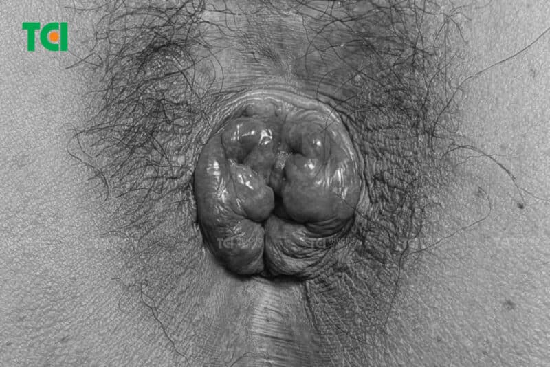 Cận cảnh búi trĩ