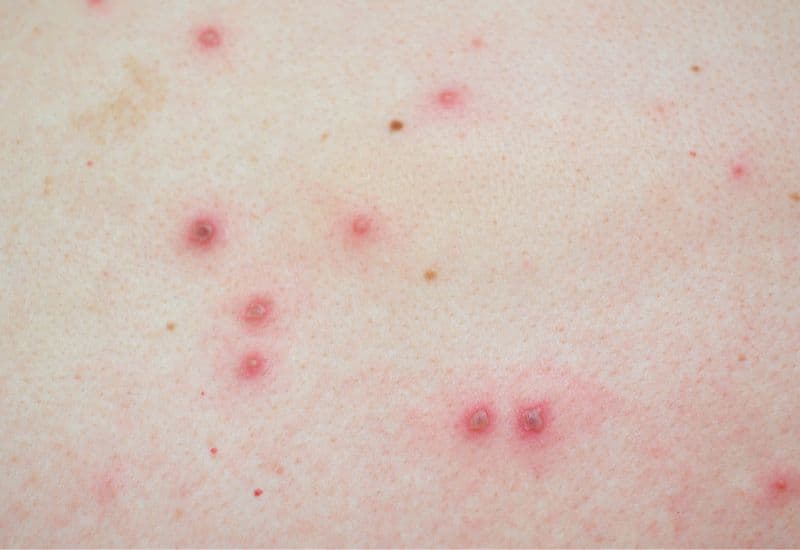 Bị thuỷ đậu có kiêng ăn cá không? - Vì sao ở Việt Nam vẫn thường khuyên kiêng cá, hải sản khi mắc thủy đậu?