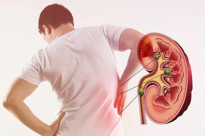 biến chứng của thận ứ nước có thể gây ra tổn thương cấu trúc thận vĩnh viễn