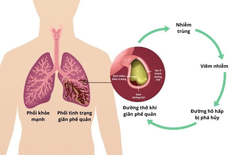 giãn phế quản sau lao