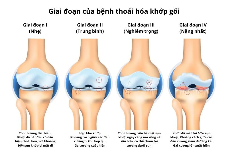 chữa thoái hóa khớp gối theo giai đoạn