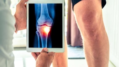 Bỏ túi 8 cách chữa thoái hóa khớp gối khoa học