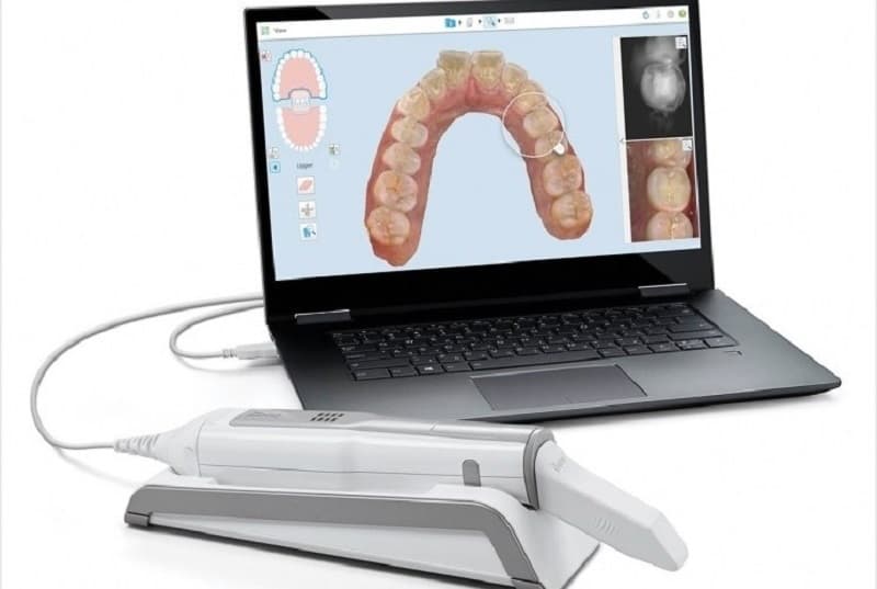 Bọc răng sứ có lấy tủy không: Công nghệ Scan 3D tiên tiến