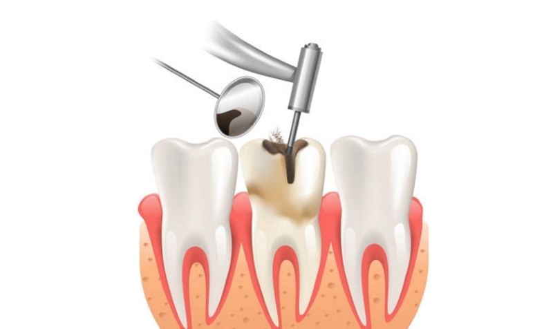 Bọc răng sứ có lấy tủy không và những điều cần lưu ý