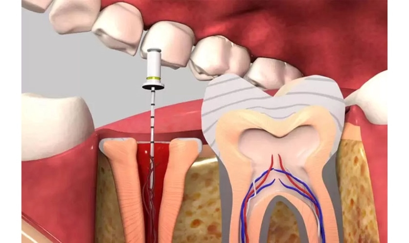 Bọc răng sứ có phải diệt tủy không: Biến chứng nguy hiểm nếu diệt tủy sai cách