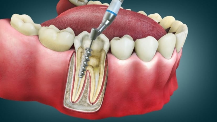 Giải đáp bọc răng sứ có phải diệt tủy không và lưu ý quan trọng