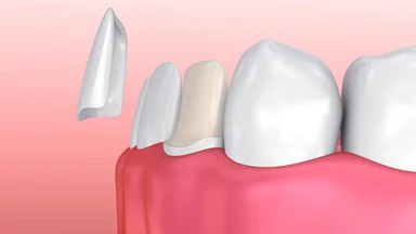 Bọc răng sứ không cần mài: Giải pháp thẩm mỹ an toàn tối đa