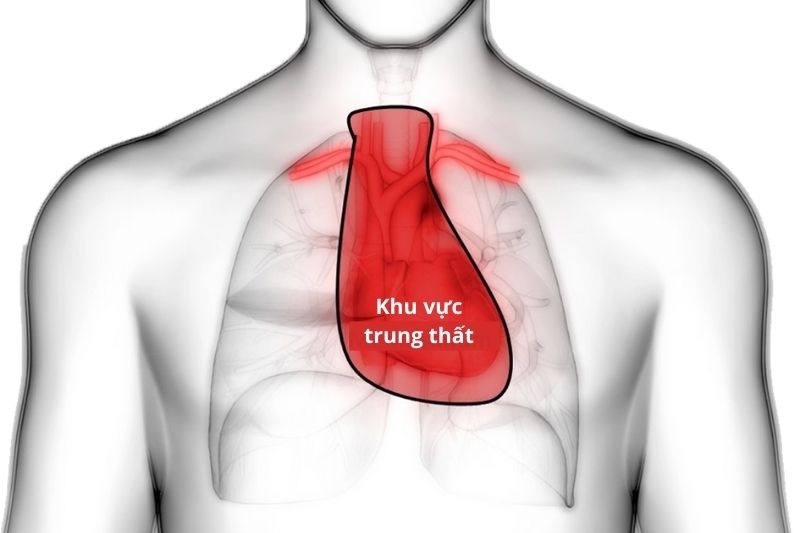 hình ảnh u trung thất
