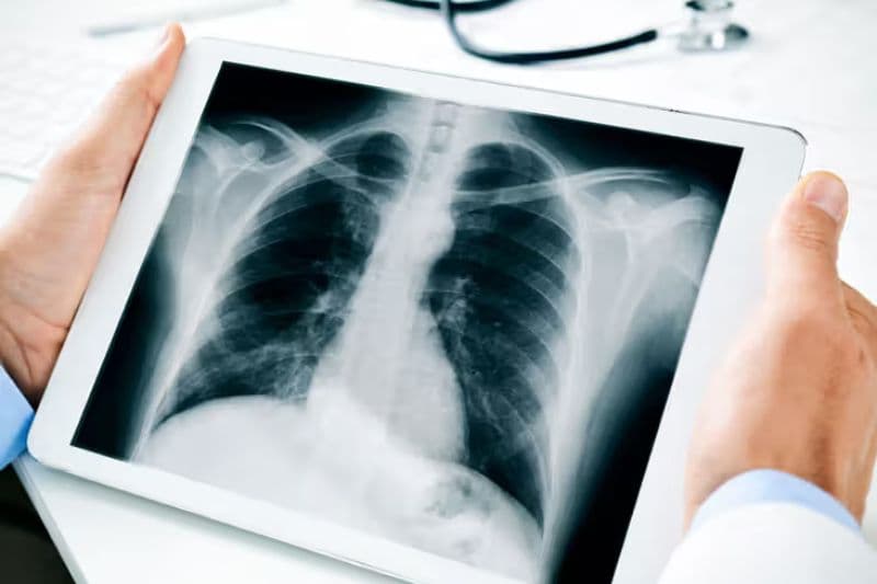 chụp hình ảnh X quang u trung thất