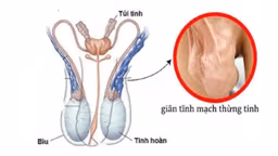 Dấu hiệu giãn tĩnh mạch thừng tinh, cơ chế, chẩn đoán và điều trị