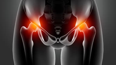 Điều trị thoái hóa khớp háng: Các phương pháp chủ yếu và lưu ý