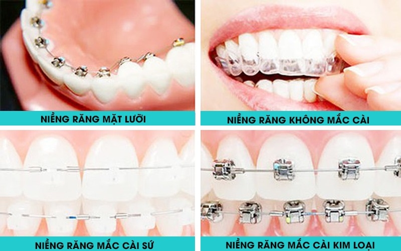 Độ tuổi niềng răng tốt nhất: Những phương pháp niềng răng phổ biến