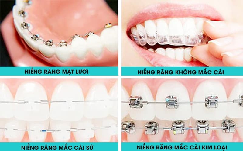 Độ tuổi niềng răng tốt nhất: Những phương pháp niềng răng phổ biến