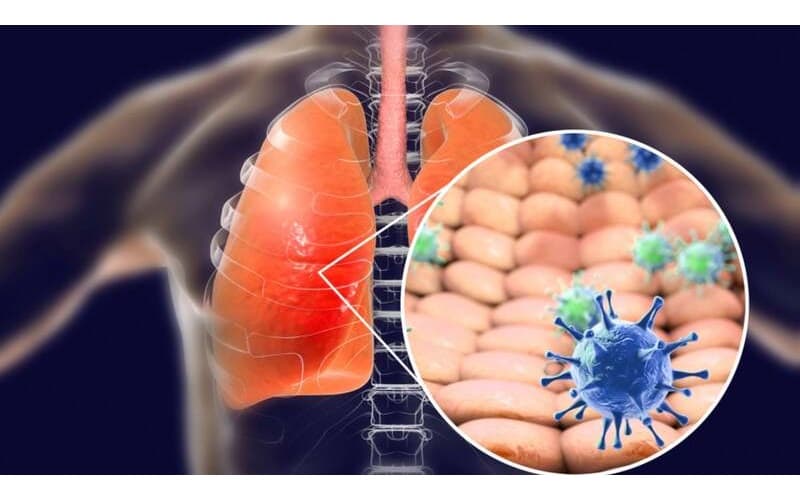Một trong những nguyên nhân phổ biến gây suy hô hấp là viêm phổi