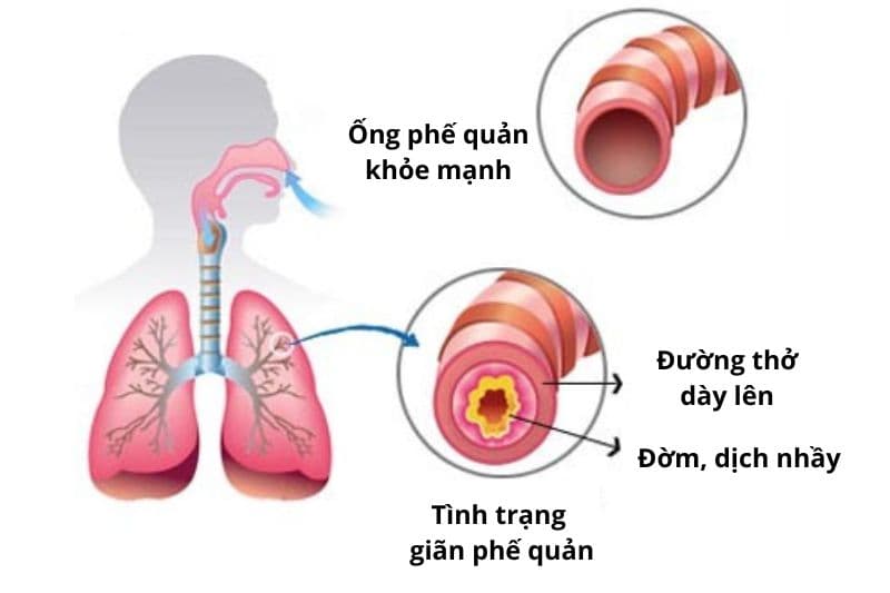 giãn phế quản có nguy hiểm không
